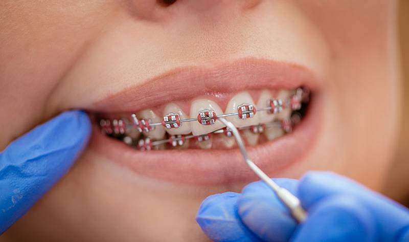 Orthodontie - Beugelbehandeling - Tandcorrectie - Orthodontische apparaten - Beugelinstallatie - Brackets - Orthodontische aanpassingen - Beugelverzorging - Tandregulatie - Retentiebeugel - Caprelian - mondhygiënist