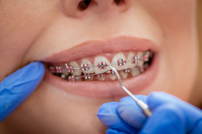 Orthodontie - Beugelbehandeling - Tandcorrectie - Orthodontische apparaten - Beugelinstallatie - Brackets - Orthodontische aanpassingen - Beugelverzorging - Tandregulatie - Retentiebeugel - Caprelian - mondhygiënist