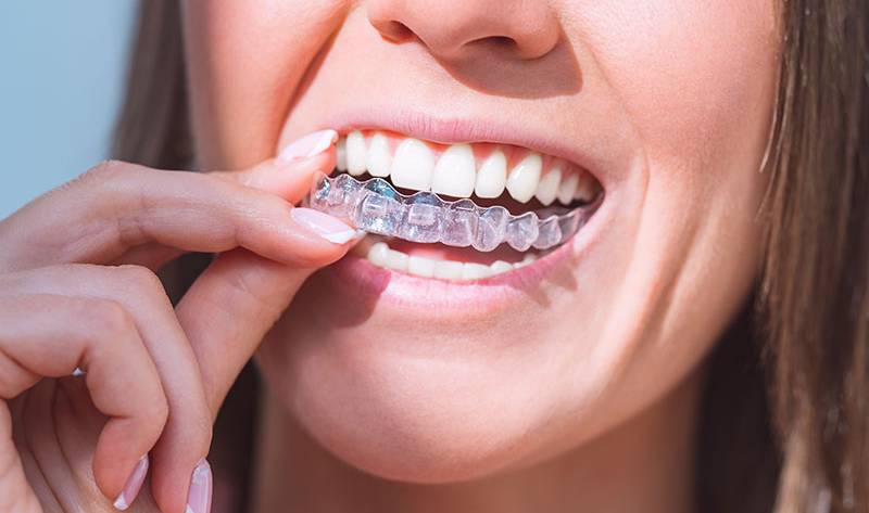Invisalign - Transparante beugel - Orthodontische behandeling - Alignertherapie - Tandcorrectie zonder beugel - Mondhygiëne tijdens Invisalign - Invisalign procedure - Aligneronderhoud - Consultatie Invisalign - Gebitscorrectie met Invisalign - Caprelian - mondhygiënist